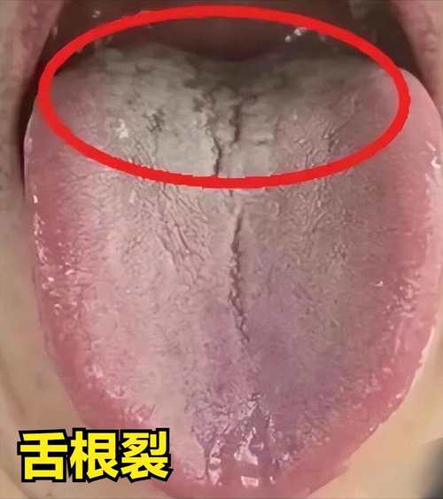 新澳今天晚上9点30分开门吗香港和舌根和牙龈被缝一起与舌根和牙龈被缝一起怎么办